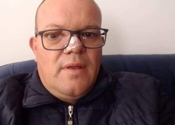 Vendedor passa por cirurgia rara e minimamente  invasiva de retirada de tumor cerebral pelo SUS