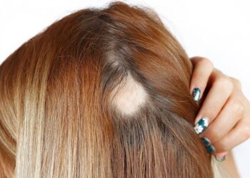 Intradermoterapia capilar e o controle de queda