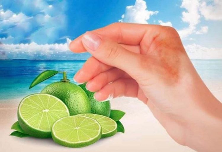 Queimaduras por alimentos no verão: muito além do limão