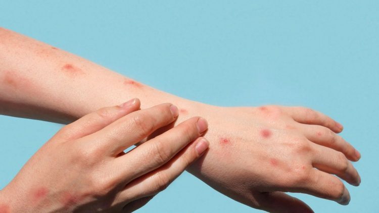 Saúde confirma 3° caso de varíola dos macacos no país