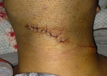 Motociclista é atingido por linha com cerol no pescoço e quase morre