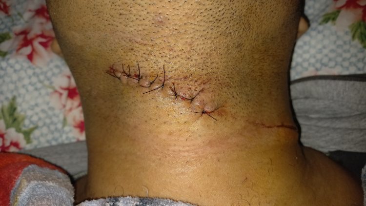 Motociclista é atingido por linha com cerol no pescoço e quase morre