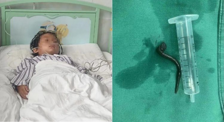 Criança que estava com “gripe” tem sanguessuga retirada da garganta