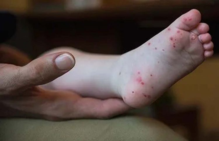 O que é a ‘gripe do tomate’, que infectou mais de cem crianças na Índia
