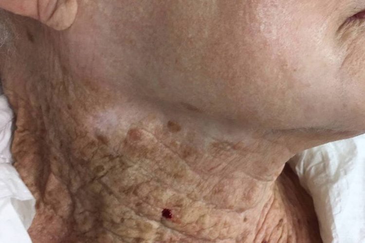 Quão danificada fica a pele do pescoço sem protetor solar?