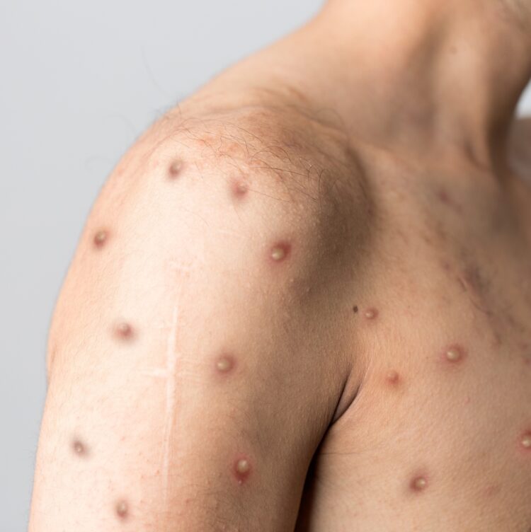 RJ confirma segunda morte por varíola dos macacos, 3º óbito no Brasil