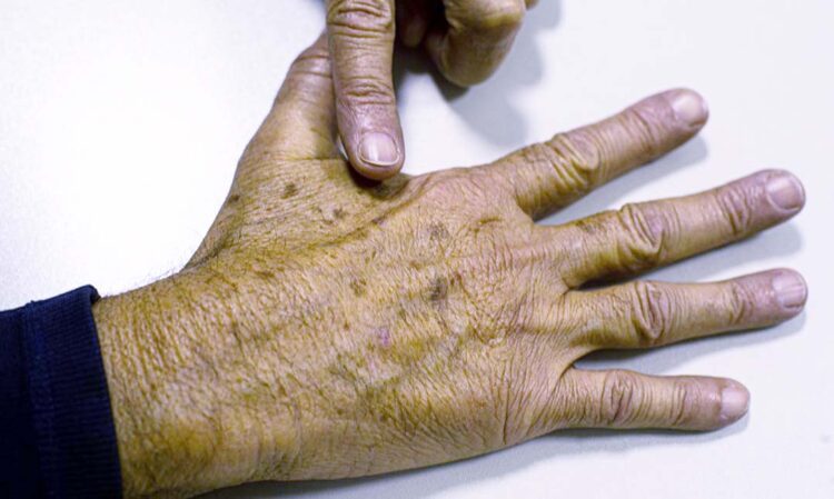 Sociedade médica lança campanha  sobre prevenção do câncer de pele