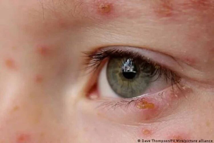 Saúde faz compra internacional de emergência de vacina contra catapora, em falta no país