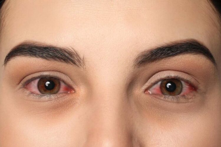 Conheça quatro tipos de conjuntivite e saiba como tratá-las