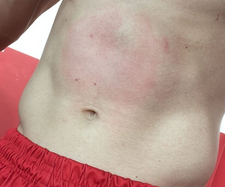 Atleta do ACP divulga marca de agressão sofrida em partida contra o Paraná Clube