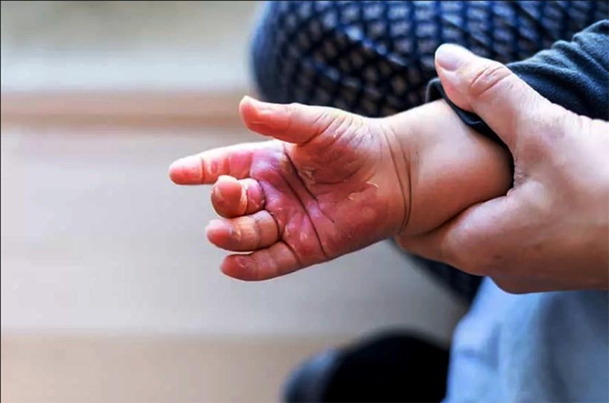 a-queima Queimaduras são de recuperação lenta e podem deixar sequelas